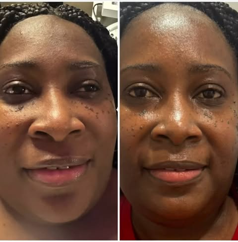 Brightening Facial Results