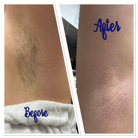 Underarm Wax Before & After